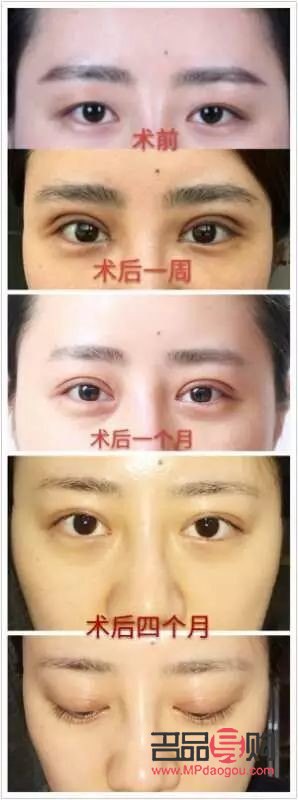 什么双眼皮恢复期最快(什么双眼皮恢复期最快呢)