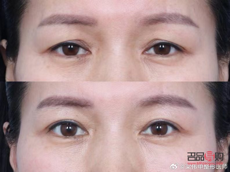 眼皮松弛了还能恢复吗图片(眼皮松弛了还能恢复吗图片大全) 眼皮松弛了还能恢复吗图片(眼皮松弛了还能恢复吗图片大全)