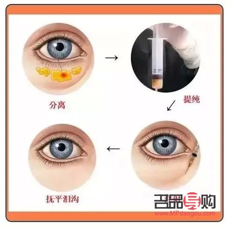 眼袋和泪沟一起做费用多少(眼袋和泪沟一起做费用多少?)