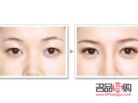 双眼皮纳米无痕与全切，哪种更优？