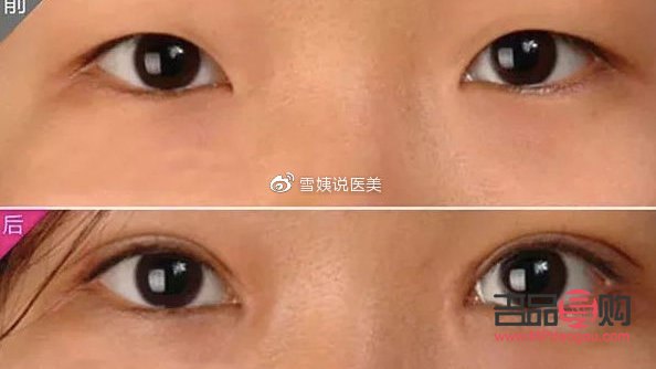 <h3>翘睫术双眼皮能保持多久恢复</h3> <h3>翘睫术双眼皮能保持多久恢复</h3>