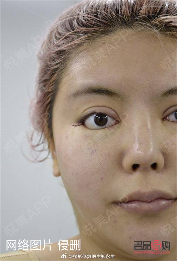 怎样把内双眼皮变成外双眼皮