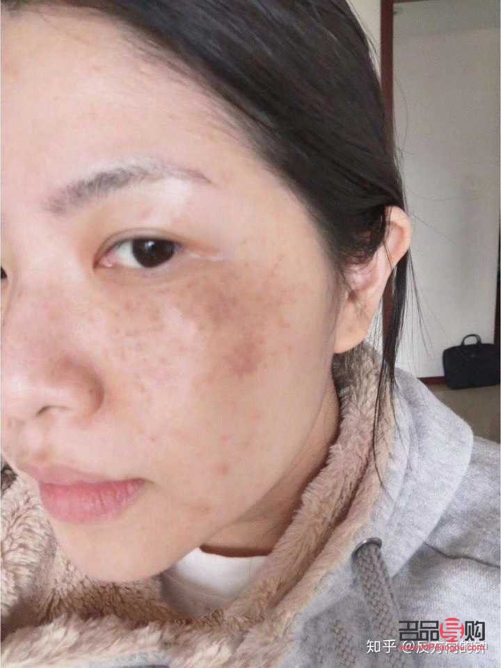 美容去斑吃什么好(美容去斑吃什么好得快)