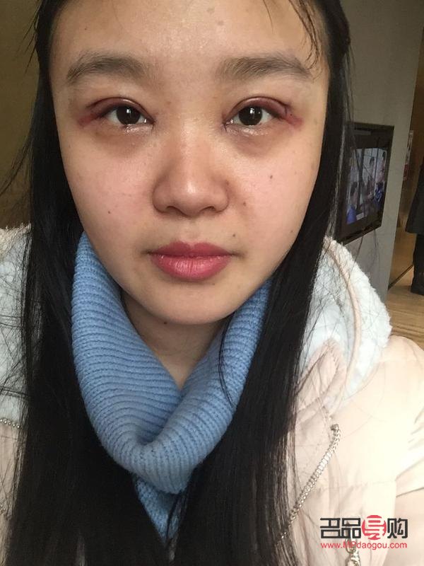 割双眼皮成内双谁的责任(割双眼皮成内双能让医院修复吗)