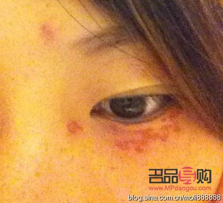 眼部汗管瘤图片(眼部汗管瘤图片是怎么形成的) 眼部汗管瘤图片(眼部汗管瘤图片是怎么形成的)