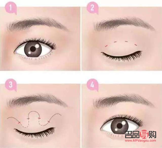 眼睛埋线多久会消失(眼睛埋线多久会消失掉) 眼睛埋线多久会消失(眼睛埋线多久会消失掉)