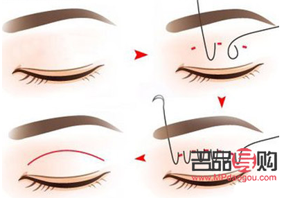 眼睛埋线多久会消失(眼睛埋线多久会消失掉) 眼睛埋线多久会消失(眼睛埋线多久会消失掉)