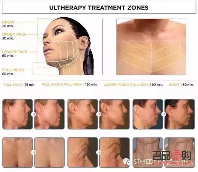 <h3>美容超声刀：肌肤紧致新选择，效果与注意事项全解析</h3>