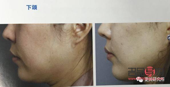 <h3>美容超声刀：肌肤紧致新选择，效果与注意事项全解析</h3>