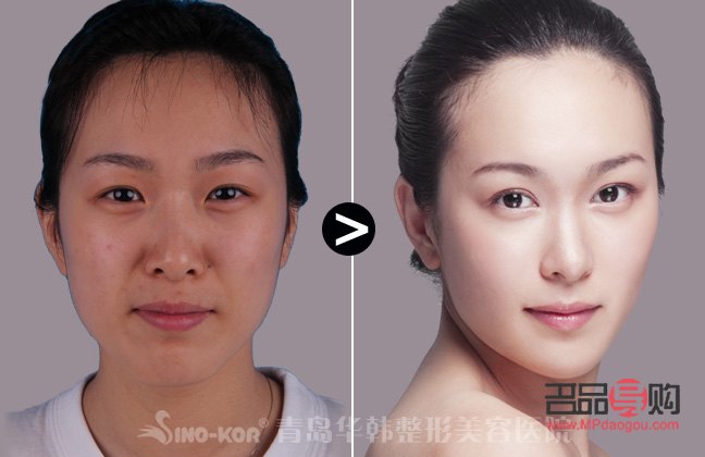 小眼睛开眼角双眼皮效果图大全(小眼睛开眼角双眼皮效果图大全图片) 小眼睛开眼角双眼皮效果图大全(小眼睛开眼角双眼皮效果图大全图片)