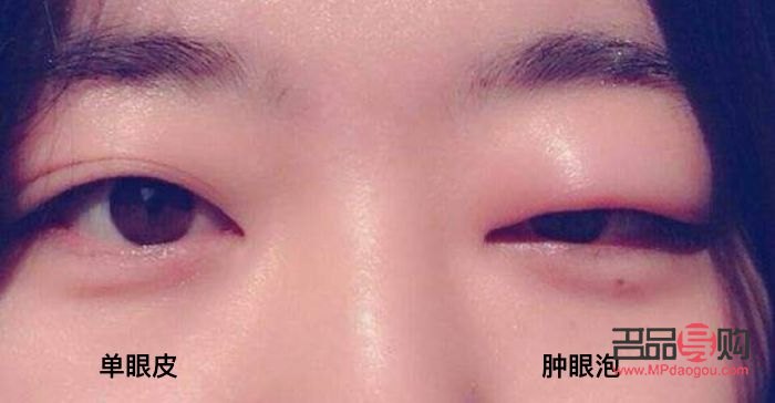 儿童肿眼泡怎么消除最快方法(儿童肿眼泡怎么消除最快方法图解) 儿童肿眼泡怎么消除最快方法(儿童肿眼泡怎么消除最快方法图解)