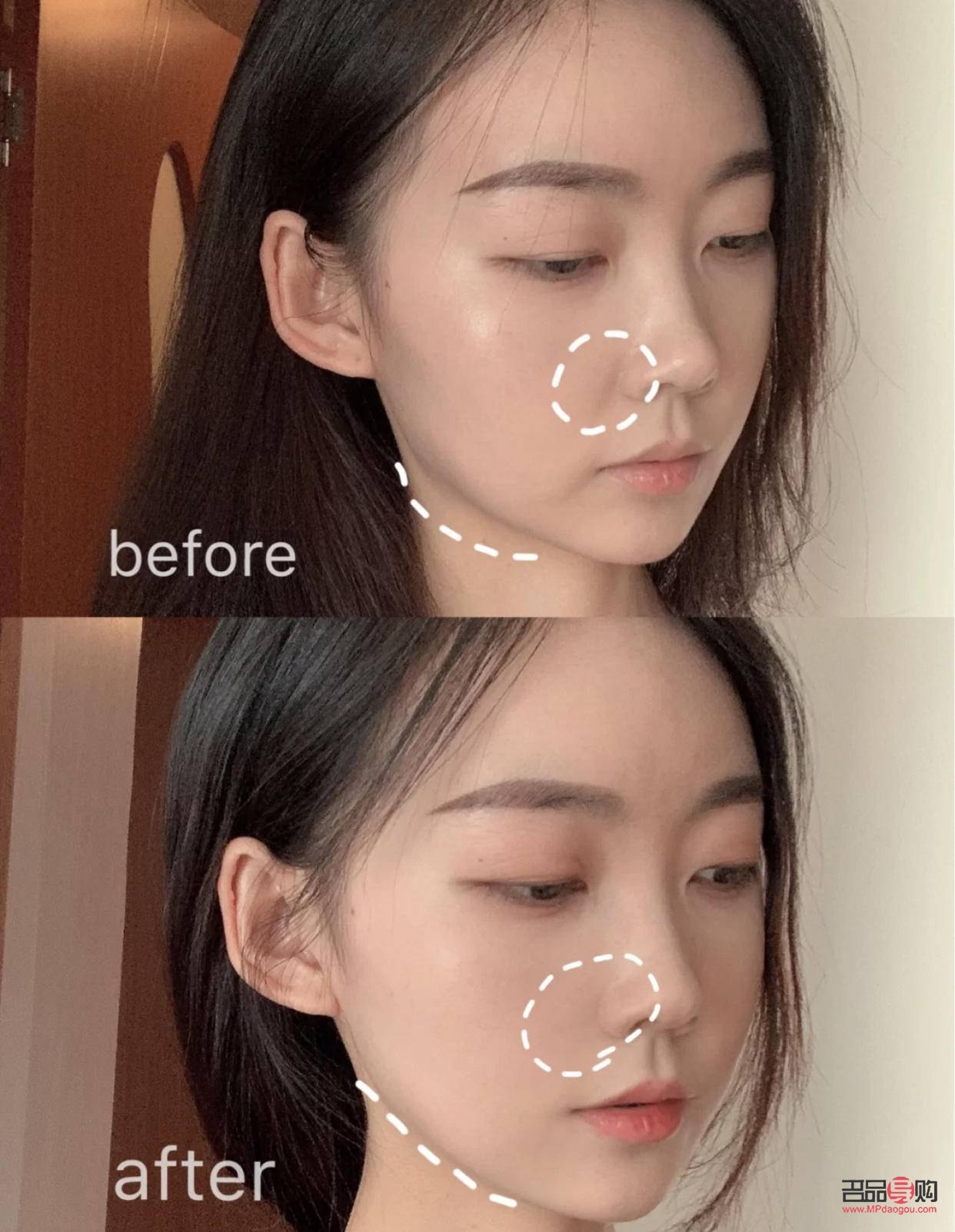 眼部热玛吉危害(眼部热玛吉副作用)