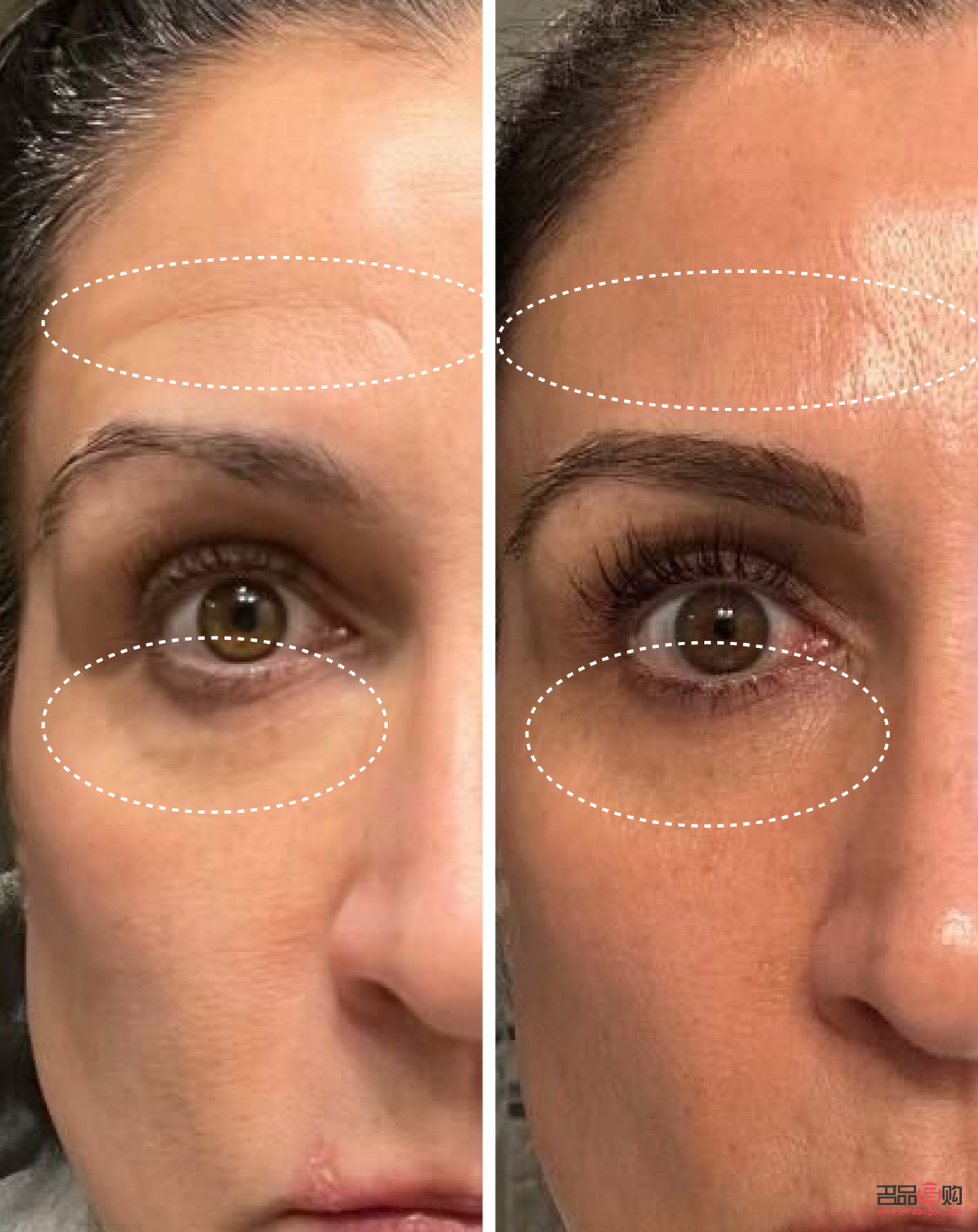 <h3>眼皮下垂缺什么营养</h3>