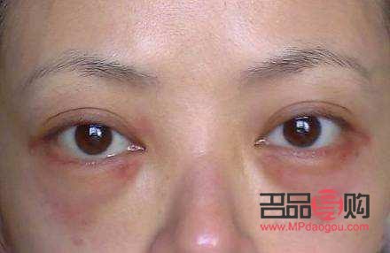 怎样消除眼袋水肿最有效的方法(怎样消除眼袋水肿最有效的方法视频)