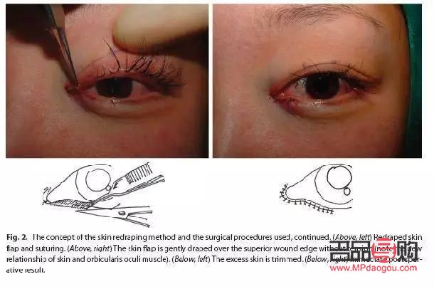 外眼角需要开吗(外眼角可以开到什么程度)