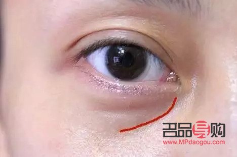 单独开眼角需要多少钱？详解价格因素及注意事项