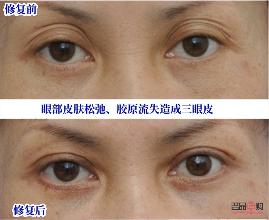 上眼皮肿怎么按摩消肿(上眼皮肿怎么按摩消肿快) 上眼皮肿怎么按摩消肿(上眼皮肿怎么按摩消肿快)