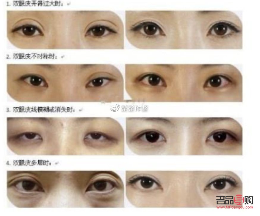 双眼皮割窄了可以加宽吗(双平面提升术全脸价格)