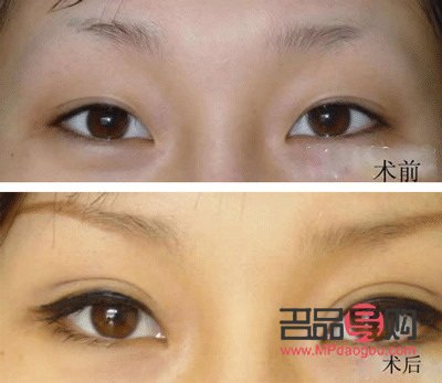 双眼皮割窄了可以加宽吗(双平面提升术全脸价格)