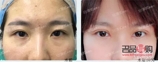 双眼皮割窄了可以加宽吗(双平面提升术全脸价格)