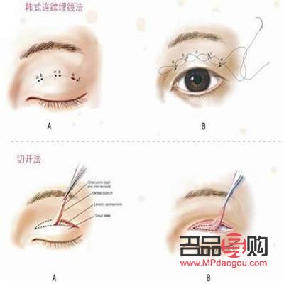 <h3>大小眼适合做哪种双眼皮</h3>