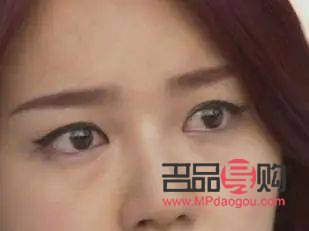 <h3>大小眼适合做哪种双眼皮</h3>