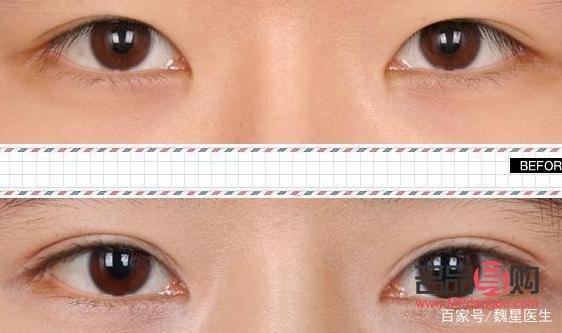 怎样可以把内双眼皮变成外双(怎样可以把内双眼皮变成外双眼皮)