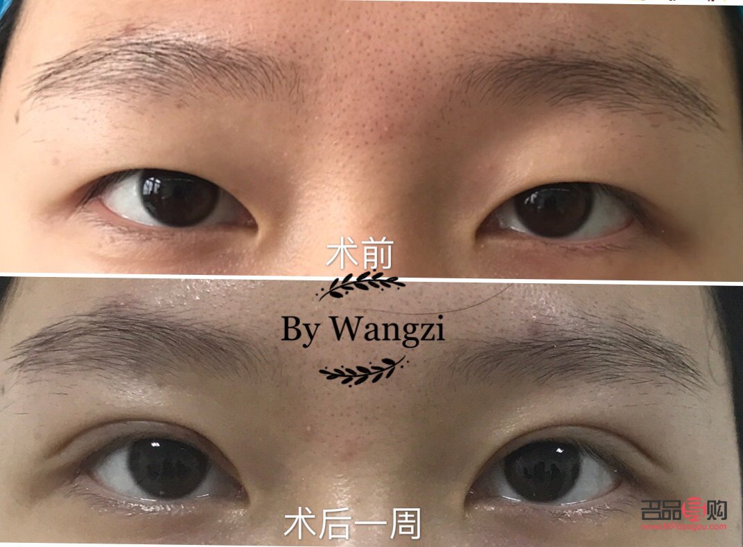 眼部抽脂前后对比照片(眼部抽脂前后对比照片侧面)