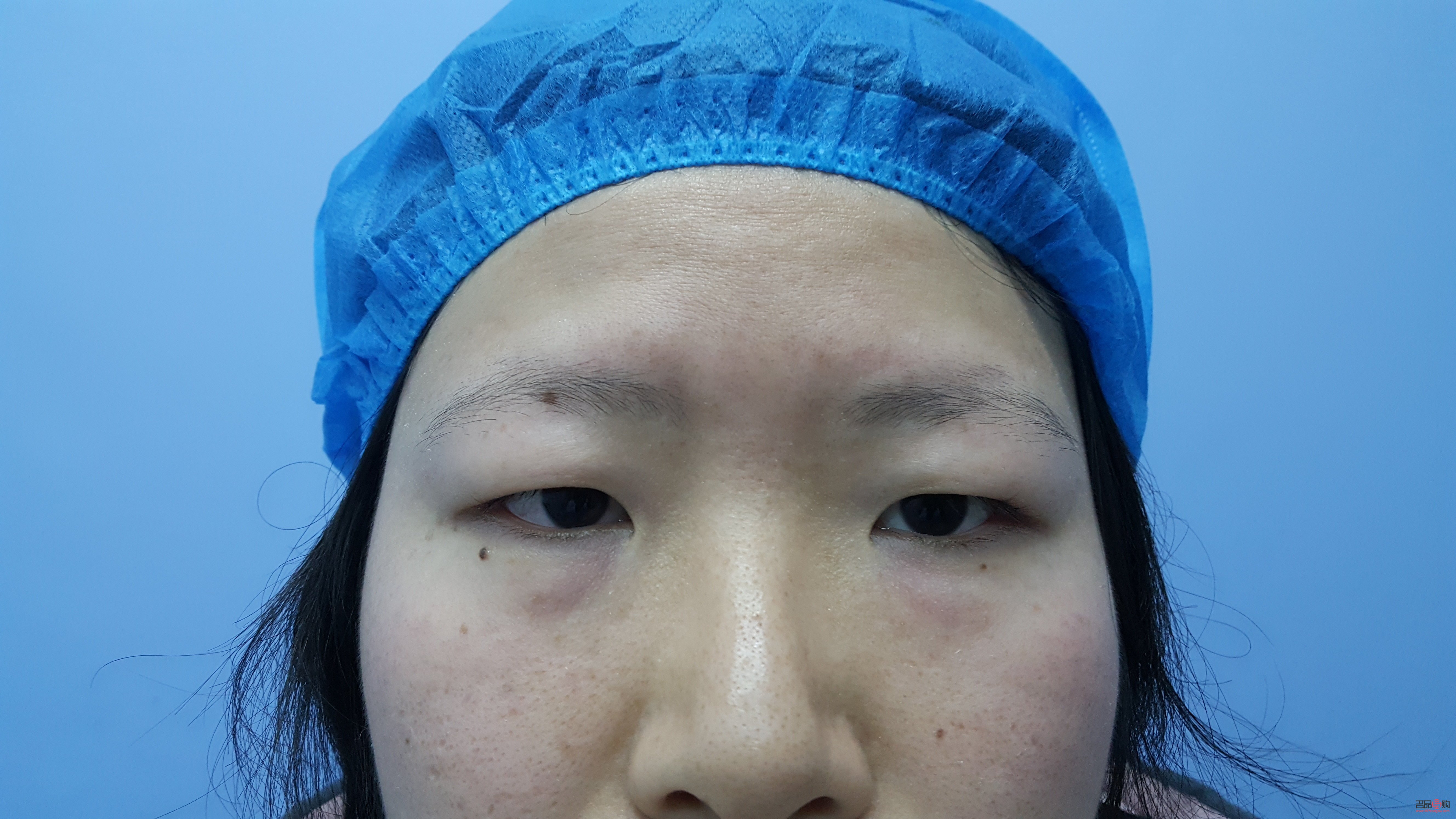 肿眼泡适合做双眼皮吗(肿眼泡适合做什么样的双眼皮)