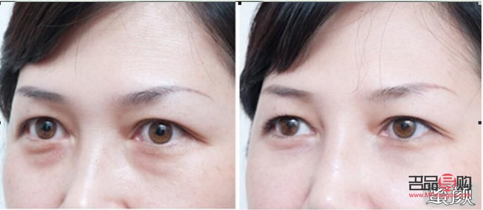 <h3>眼袋手术失败案例分析与警示</h3>