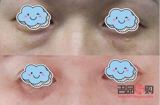 <h3>眼袋手术失败案例分析与警示</h3>