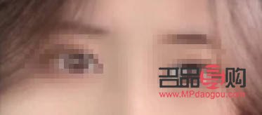 填充眼窝凹陷脂肪存活率高吗(填充眼窝凹陷脂肪存活率高吗?)