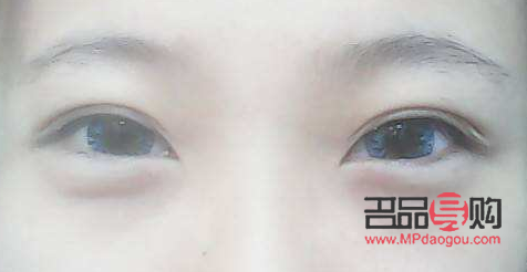 微创眼袋手术视频(微创眼袋手术视频全过程) 微创眼袋手术视频(微创眼袋手术视频全过程)