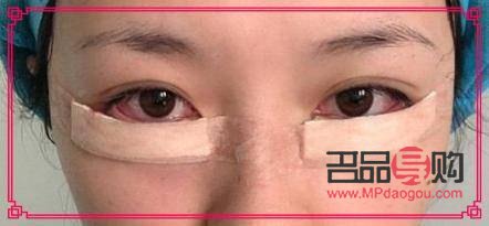 微创眼袋手术视频(微创眼袋手术视频全过程)