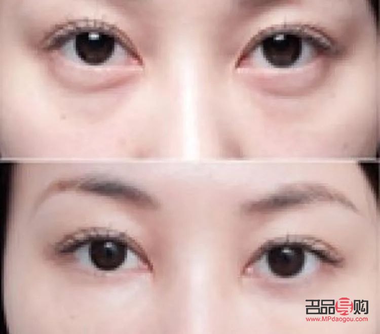 眼袋与卧蚕的区别图片对比：了解差异，打造美丽眼部