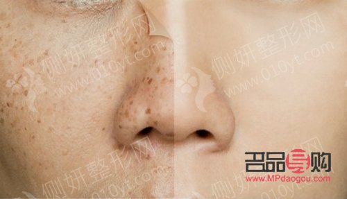 <h3>美容祛斑要多少钱？全面解析祛斑费用及影响因素</h3>