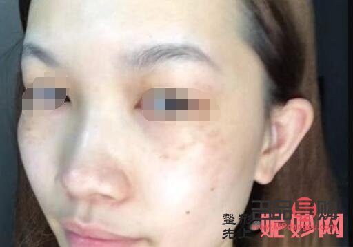 <h3>美容祛斑要多少钱？全面解析祛斑费用及影响因素</h3>