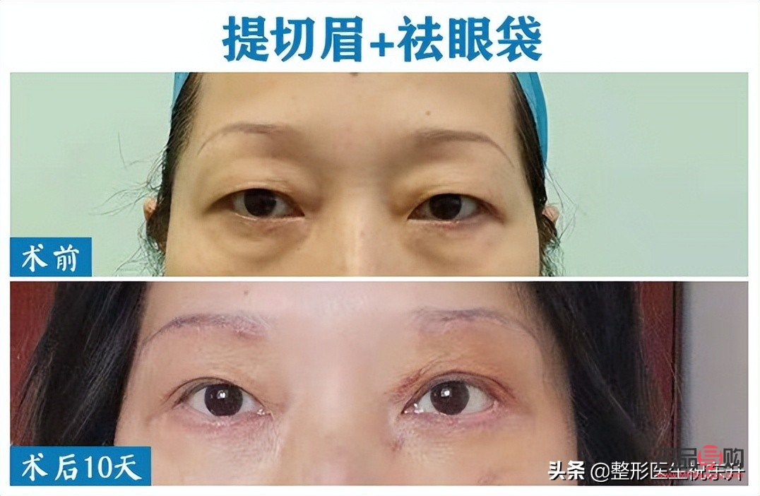 切双眼皮和提眉哪种效果好(切双眼皮和提眉哪种效果好些)