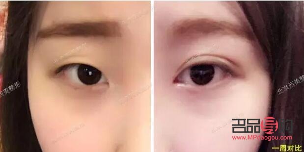 开扇6mm双眼皮图片(开扇6mm双眼皮图片真实)