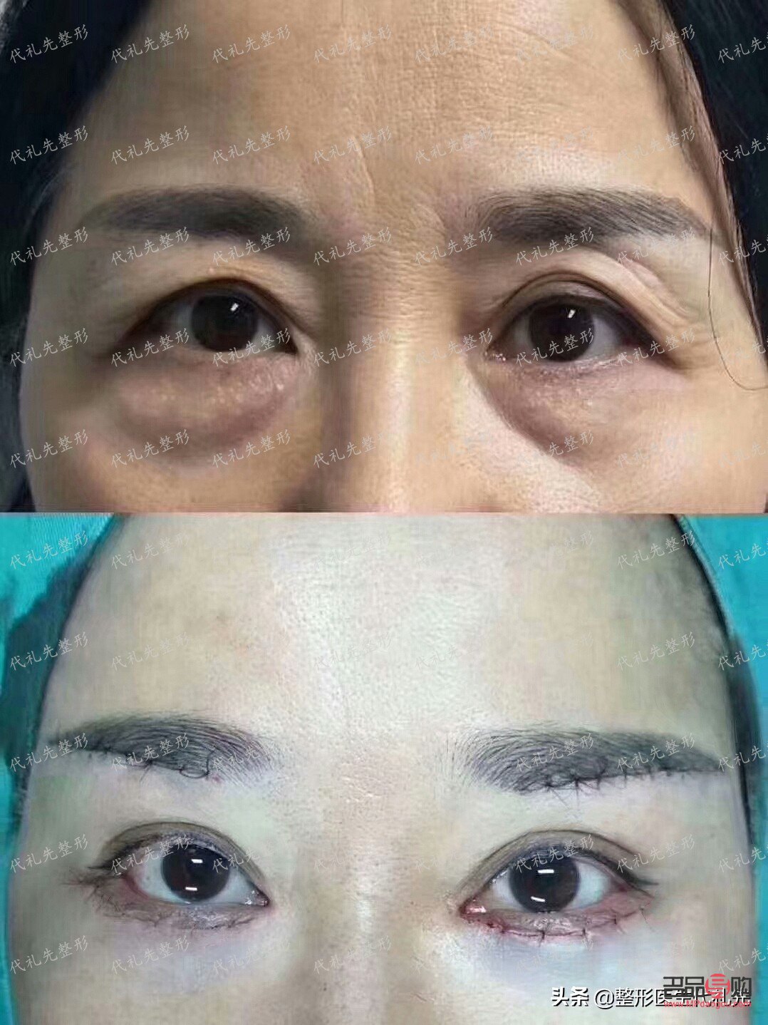 怎么消除眼袋最有效的办法(怎么消除眼袋最有效的办法松弛)