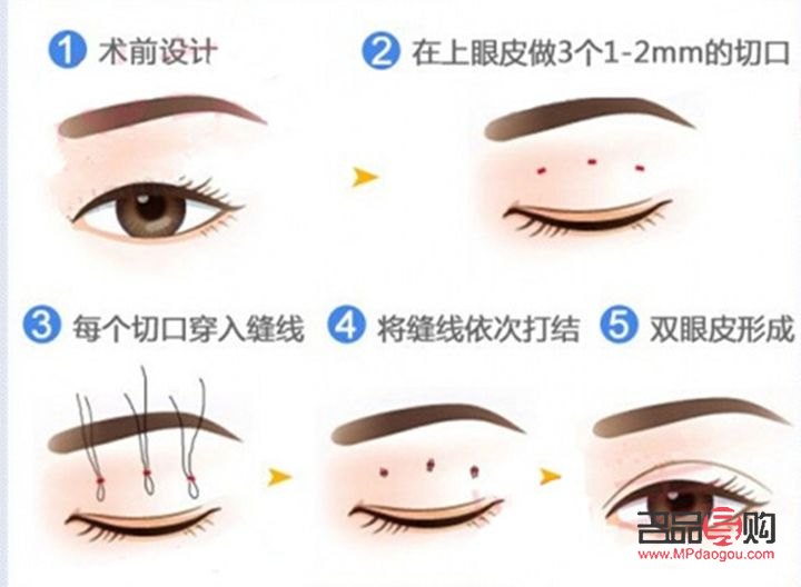 双眼皮哪一种做的效果好(双眼皮哪一种做的效果好些) 双眼皮哪一种做的效果好(双眼皮哪一种做的效果好些)