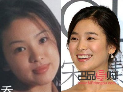 平行双眼皮图片前后对比图大揭秘，打造迷人电眼新境界！