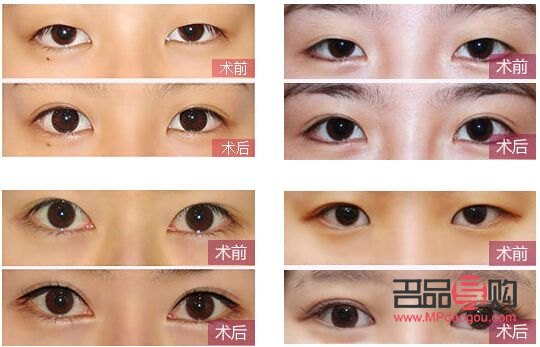 眼睛一大一小矫正费用多少(眼睛一大一小矫正要多少钱) 眼睛一大一小矫正费用多少(眼睛一大一小矫正要多少钱)