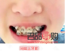 眼睛一大一小矫正费用多少(眼睛一大一小矫正要多少钱)