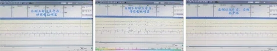 脊髓电刺激术突破性治愈神经纤维瘤术后13年顽固疼痛｜解放军总医院成功案例