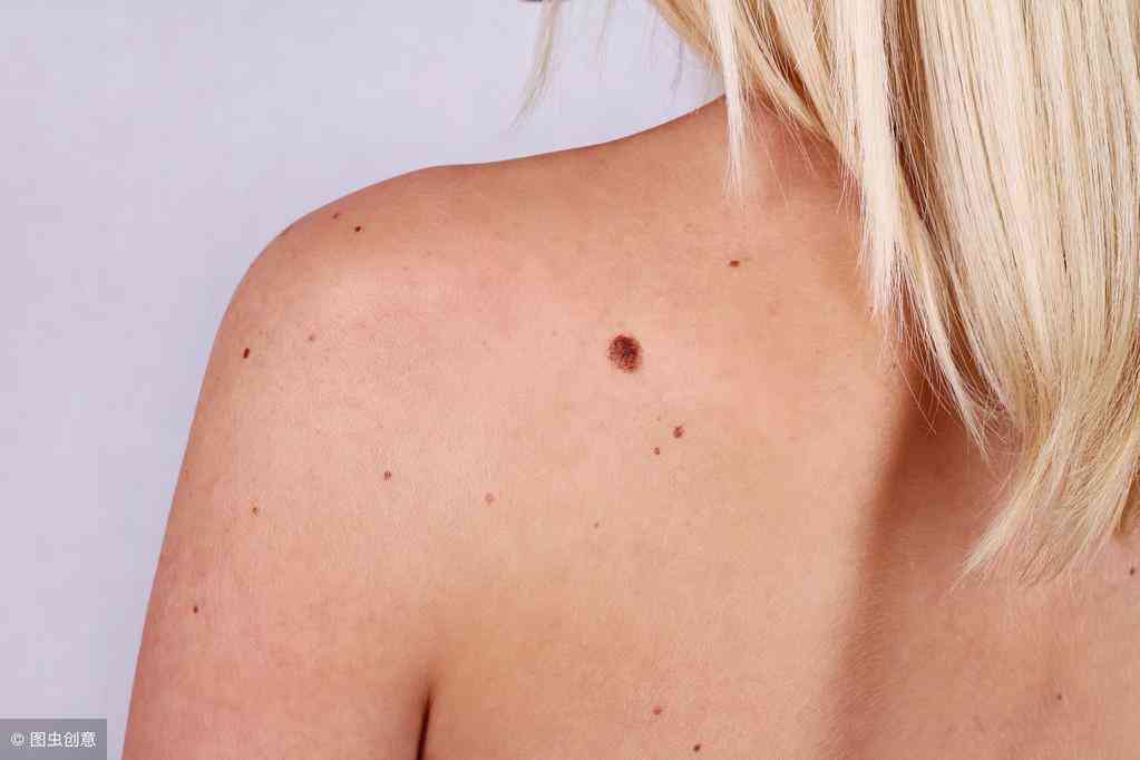 怎么遮痣不用化妆品处理(怎么遮痣不用化妆品处理掉)