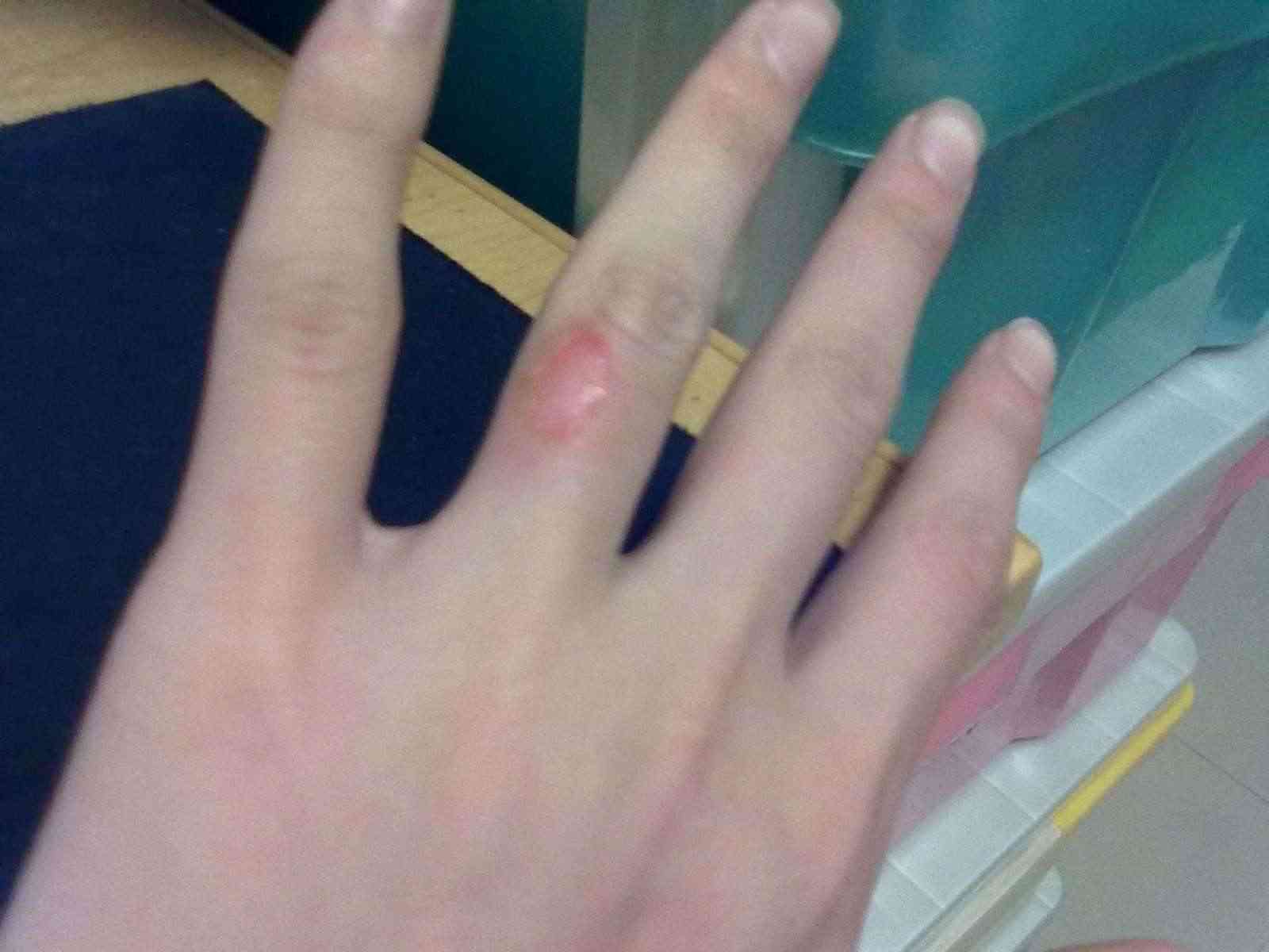 火烫了以后能擦化妆品吗(火烫了以后能擦化妆品吗图片)