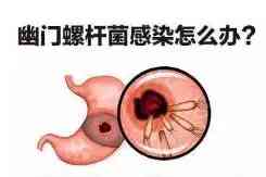 克拉霉素缓释片说明书(克拉霉素缓释片说明书明书)