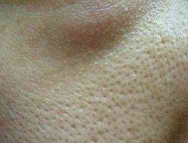 用了化妆品后毛孔粗大(用完护肤品毛孔粗大)