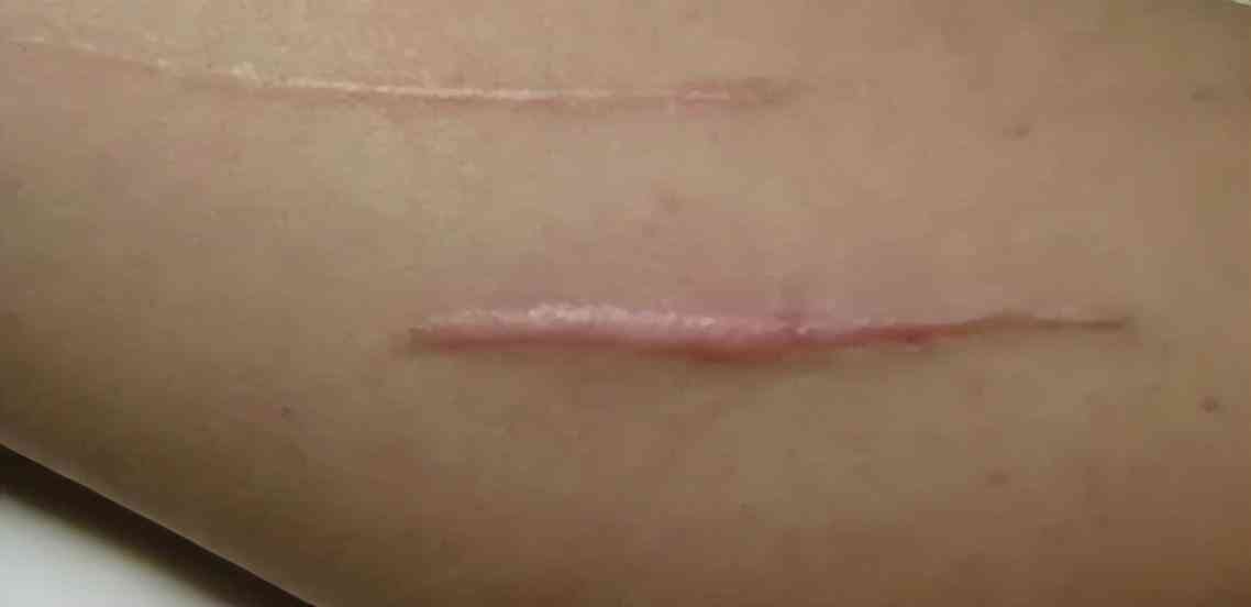 良心国货化妆品消疤(国货祛疤膏)插图8